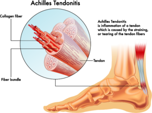 CBD and Achilles Tendonitis