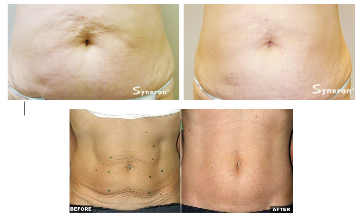 Velashape for the Abdomen