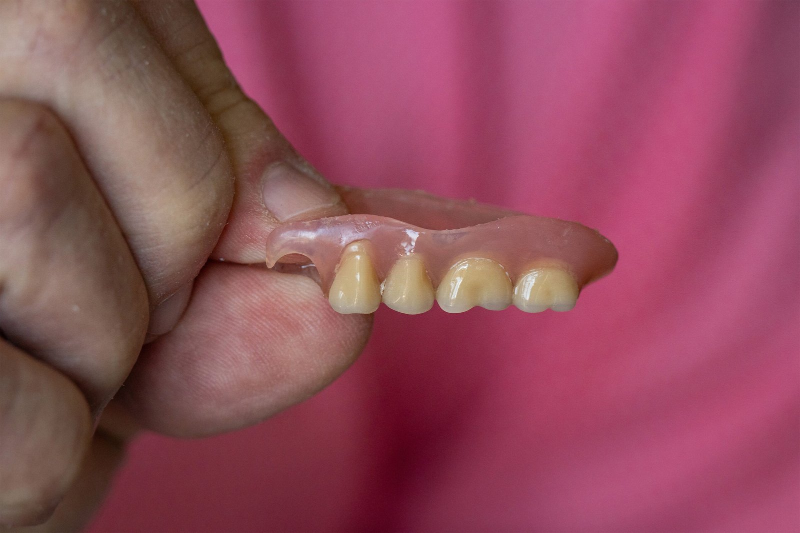 Medi-Cal’s Dental Care Gap: Getting a Tooth Pulled Is Easy — Much Harder To Get an Implant