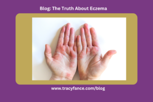 The Truth About Eczema