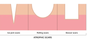 Acne scarring – assessment and treatments